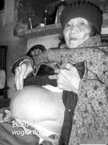 四川一91岁老奶奶不慎摔倒，到医院后发现怀孕了（60年前怀上的）